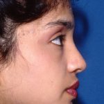 Ethnic Rhinoplasty Before & After Patient #2037