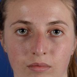 Primary Rhinoplasty Before & After Patient #1720