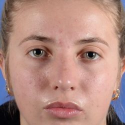 Primary Rhinoplasty Before & After Patient #1720