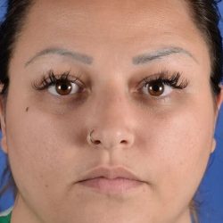 Buccal Fat Removal Before & After Patient #2115