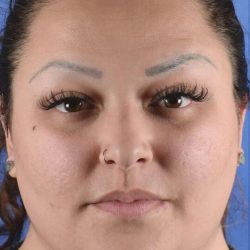 Buccal Fat Removal Before & After Patient #2115