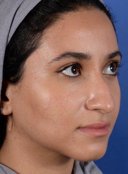 Ethnic Rhinoplasty Before & After Patient #2039