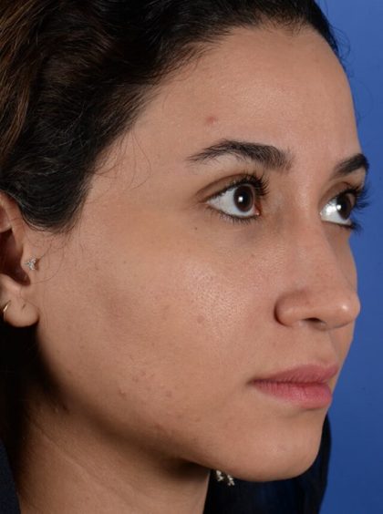 Ethnic Rhinoplasty Before & After Patient #2039