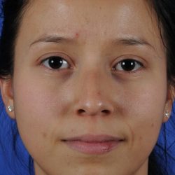Ethnic Rhinoplasty Before & After Patient #2040