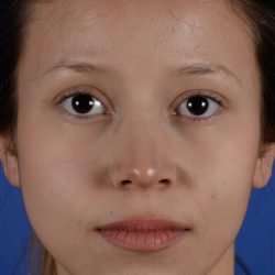 Ethnic Rhinoplasty Before & After Patient #2040