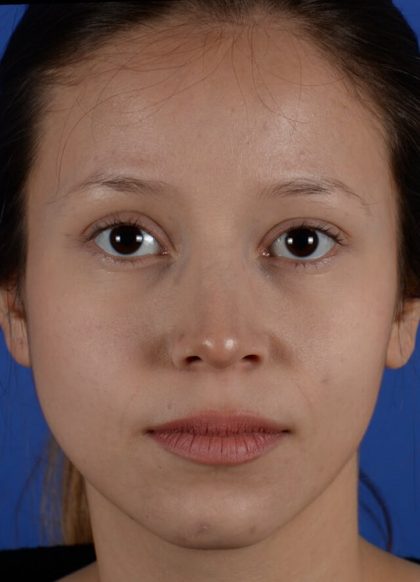 Ethnic Rhinoplasty Before & After Patient #2040