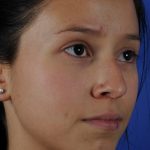 Ethnic Rhinoplasty Before & After Patient #2040