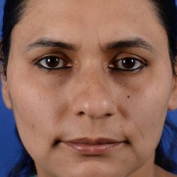 Ethnic Rhinoplasty Before & After Patient #2041