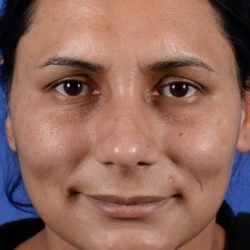 Ethnic Rhinoplasty Before & After Patient #2041