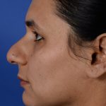 Ethnic Rhinoplasty Before & After Patient #2041