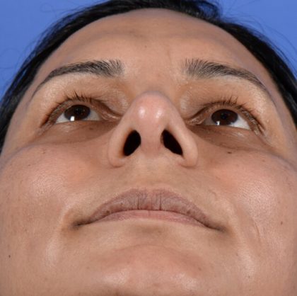 Ethnic Rhinoplasty Before & After Patient #2041