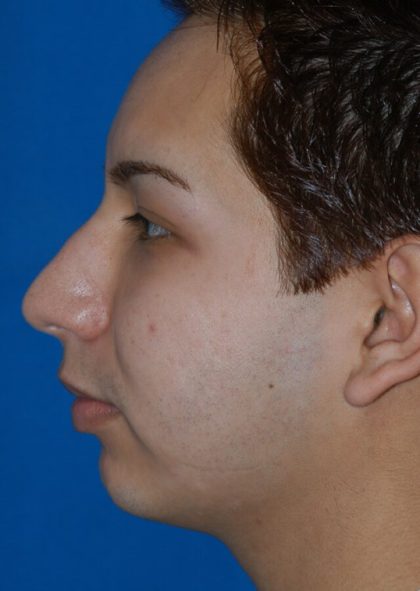 Ethnic Rhinoplasty Before & After Patient #2042