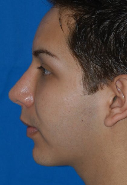 Ethnic Rhinoplasty Before & After Patient #2042