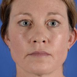Facial Fat Transfer Before & After Patient #2327
