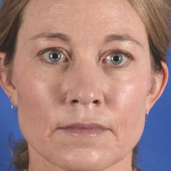 Facial Fat Transfer Before & After Patient #2327