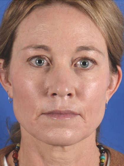 Facial Fat Transfer Before & After Patient #2327