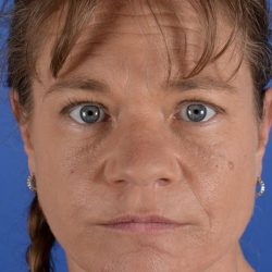 Primary Rhinoplasty Before & After Patient #1768