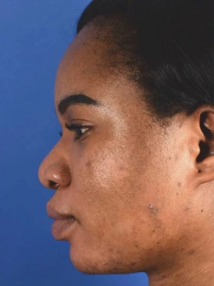 Ethnic Rhinoplasty Before & After Patient #2043