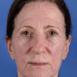 Forehead Lift Brow Lift Before & After Patient #2365