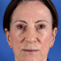 Forehead Lift Brow Lift Before & After Patient #2365