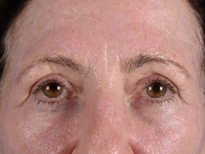 Forehead Lift Brow Lift Before & After Patient #2365