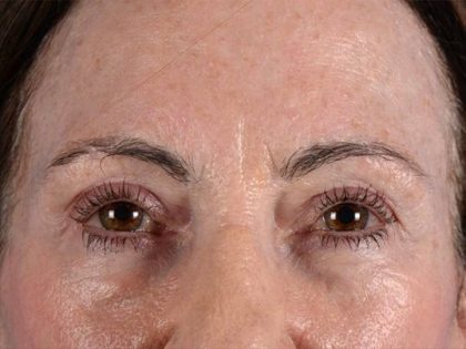 Forehead Lift Brow Lift Before & After Patient #2365