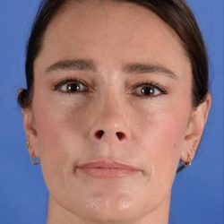Facial Fat Transfer Before & After Patient #2328