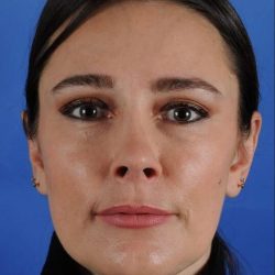 Facial Fat Transfer Before & After Patient #2328