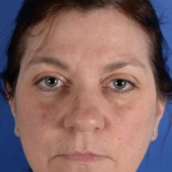 Primary Rhinoplasty Before & After Patient #1770