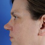 Primary Rhinoplasty Before & After Patient #1770