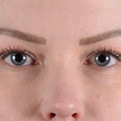 Blepharoplasty Before & After Patient #2207