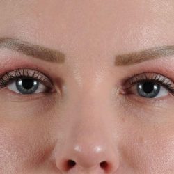 Blepharoplasty Before & After Patient #2207