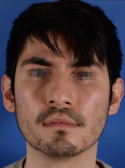 Ethnic Rhinoplasty Before & After Patient #2044