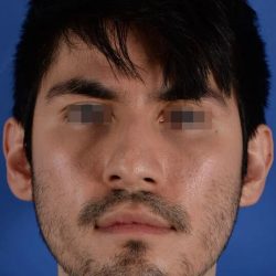 Primary Rhinoplasty Before & After Patient #1771