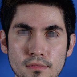 Primary Rhinoplasty Before & After Patient #1771
