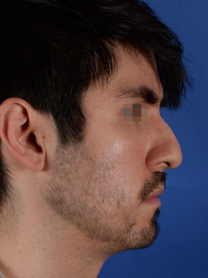 Ethnic Rhinoplasty Before & After Patient #2044
