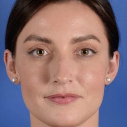 Primary Rhinoplasty Before & After Patient #1772