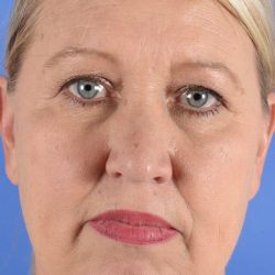 Blepharoplasty Before & After Patient #2208