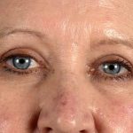 Blepharoplasty Before & After Patient #2208