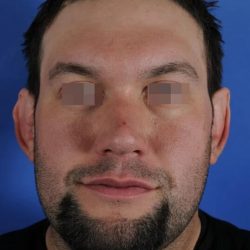 Otoplasty Before & After Patient #2111