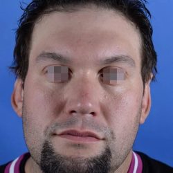 Otoplasty Before & After Patient #2111