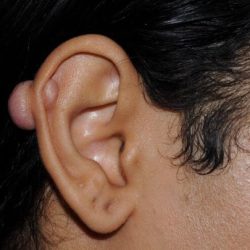 Otoplasty Before & After Patient #2112