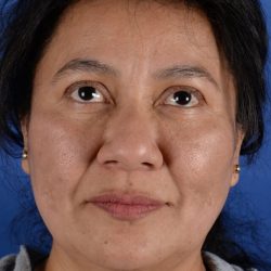 Face Lift - Neck Lift Before & After Patient #2279