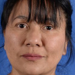 Face Lift - Neck Lift Before & After Patient #2279