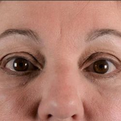 Blepharoplasty Before & After Patient #2209