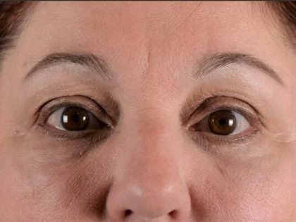 Blepharoplasty Before & After Patient #2209