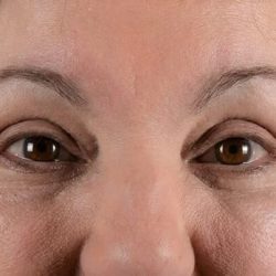 Blepharoplasty Before & After Patient #2209