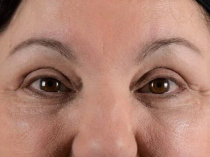Blepharoplasty Before & After Patient #2209