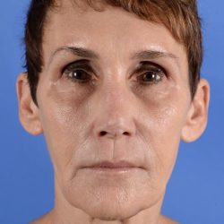 Face Lift - Neck Lift Before & After Patient #2280