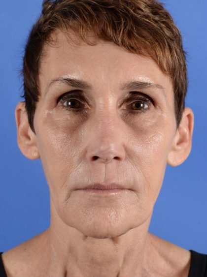 Facelift Neck Lift Before & After Patient #2280